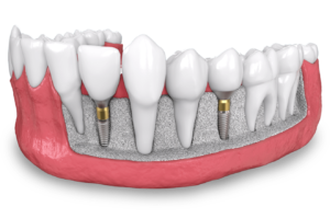 dental implant model Leesburg, VA