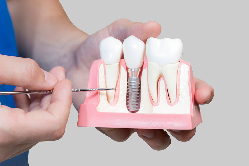 a dental implant model with a bone cutaway showing the dental implant post.