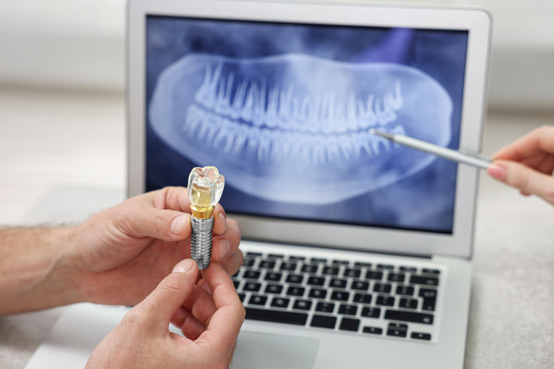 dental implant being shown in front of an x-ray