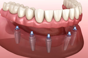 denture supported implants showing 6 implants on the jaw for placement of the arch