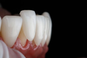 porcelain veneers being placed onto the tooth