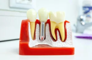 dental implants leesburg va model
