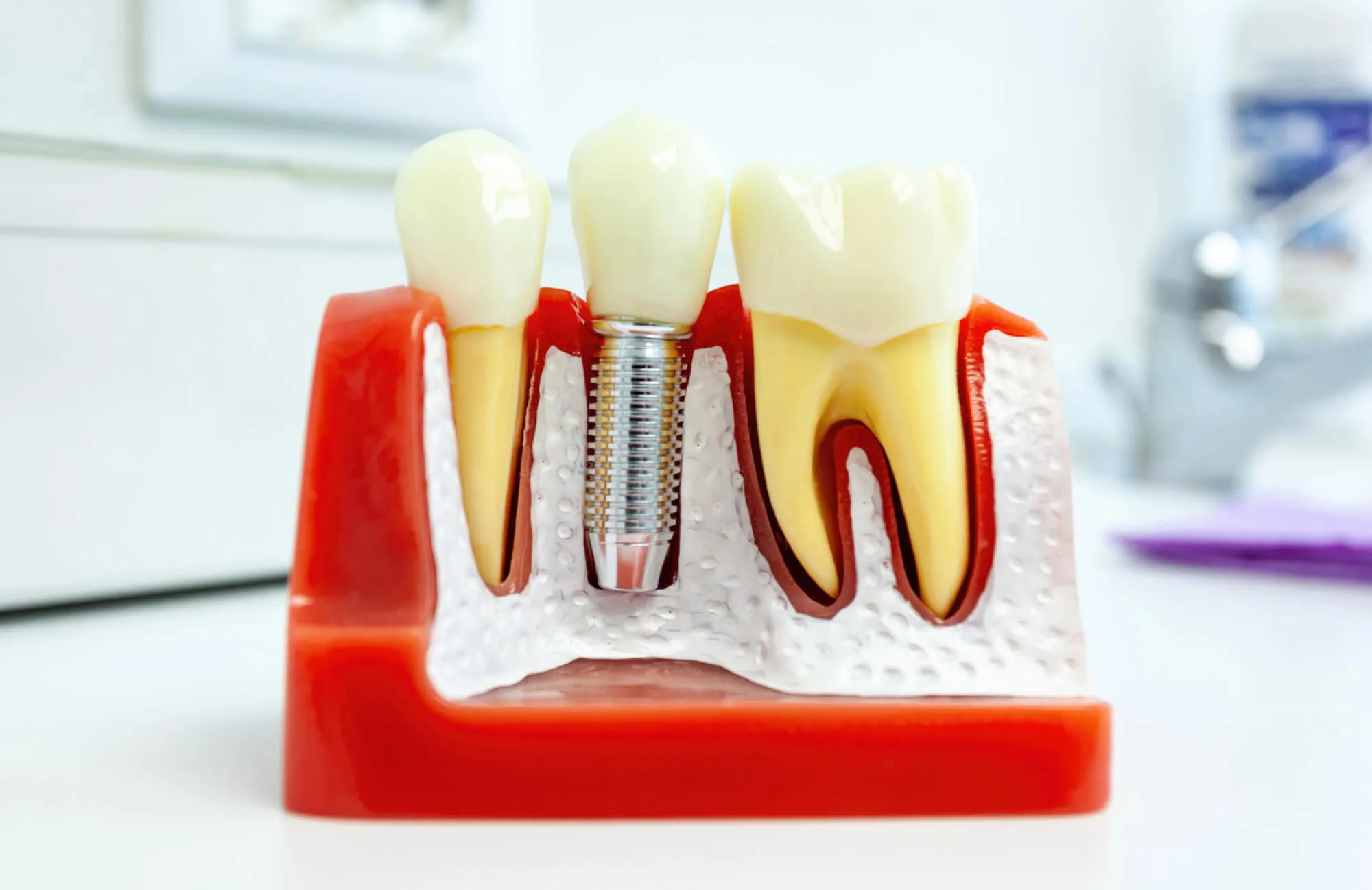dental implants leesburg va model