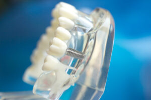 full mouth dental implants leesburg va model