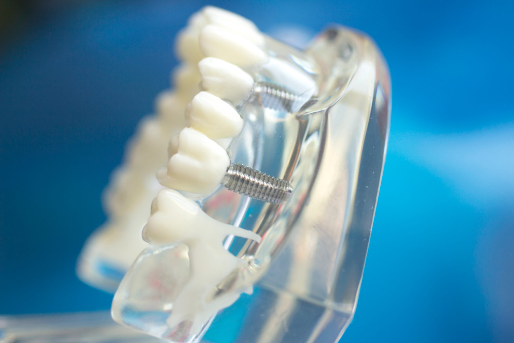 full mouth dental implants leesburg va model