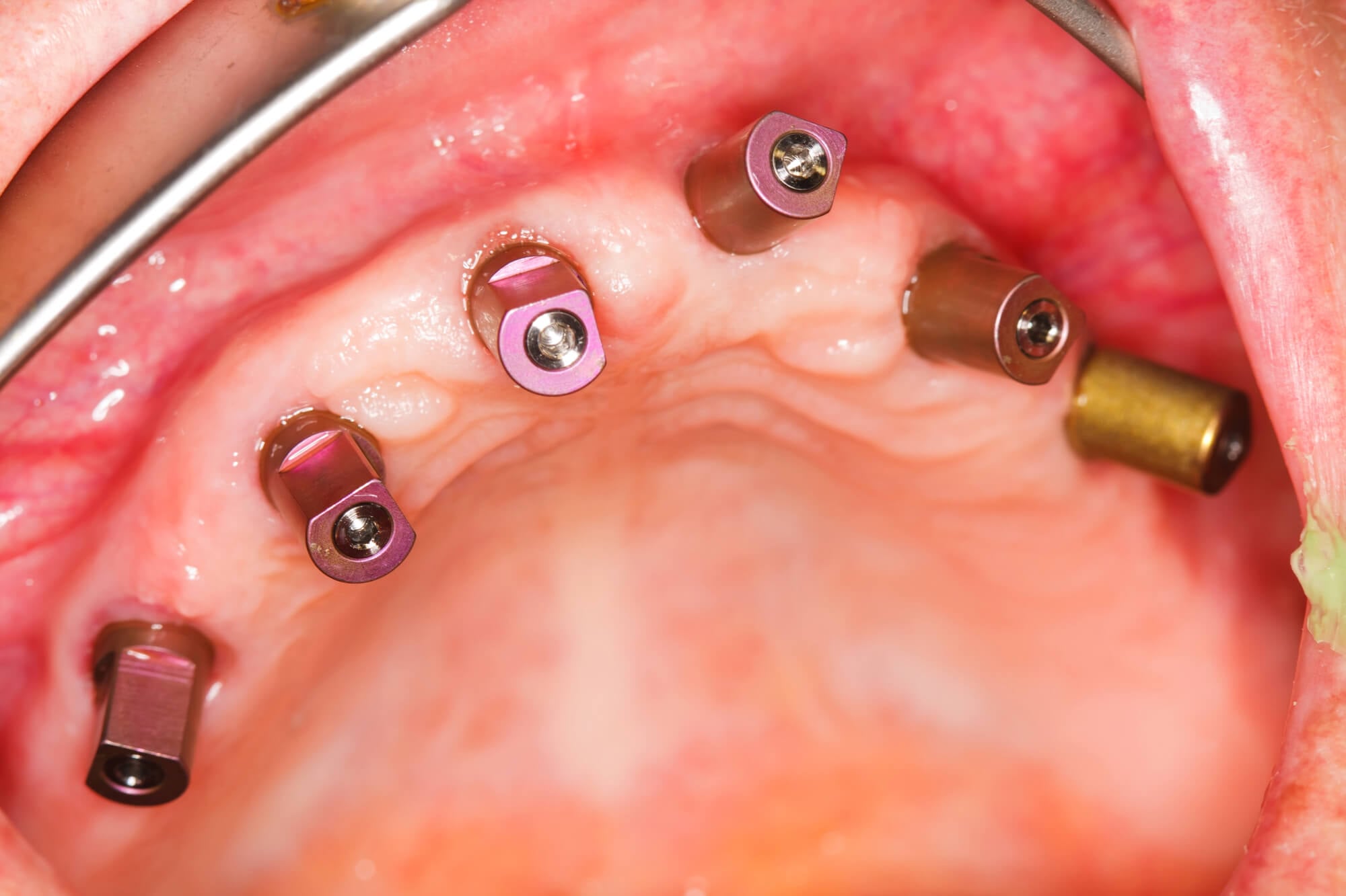 full mouth dental implants leesburg va