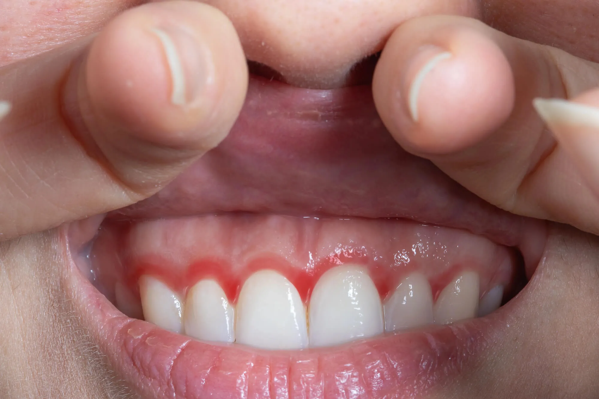 patient with bleeding gums looking for a dentist near me leesburg