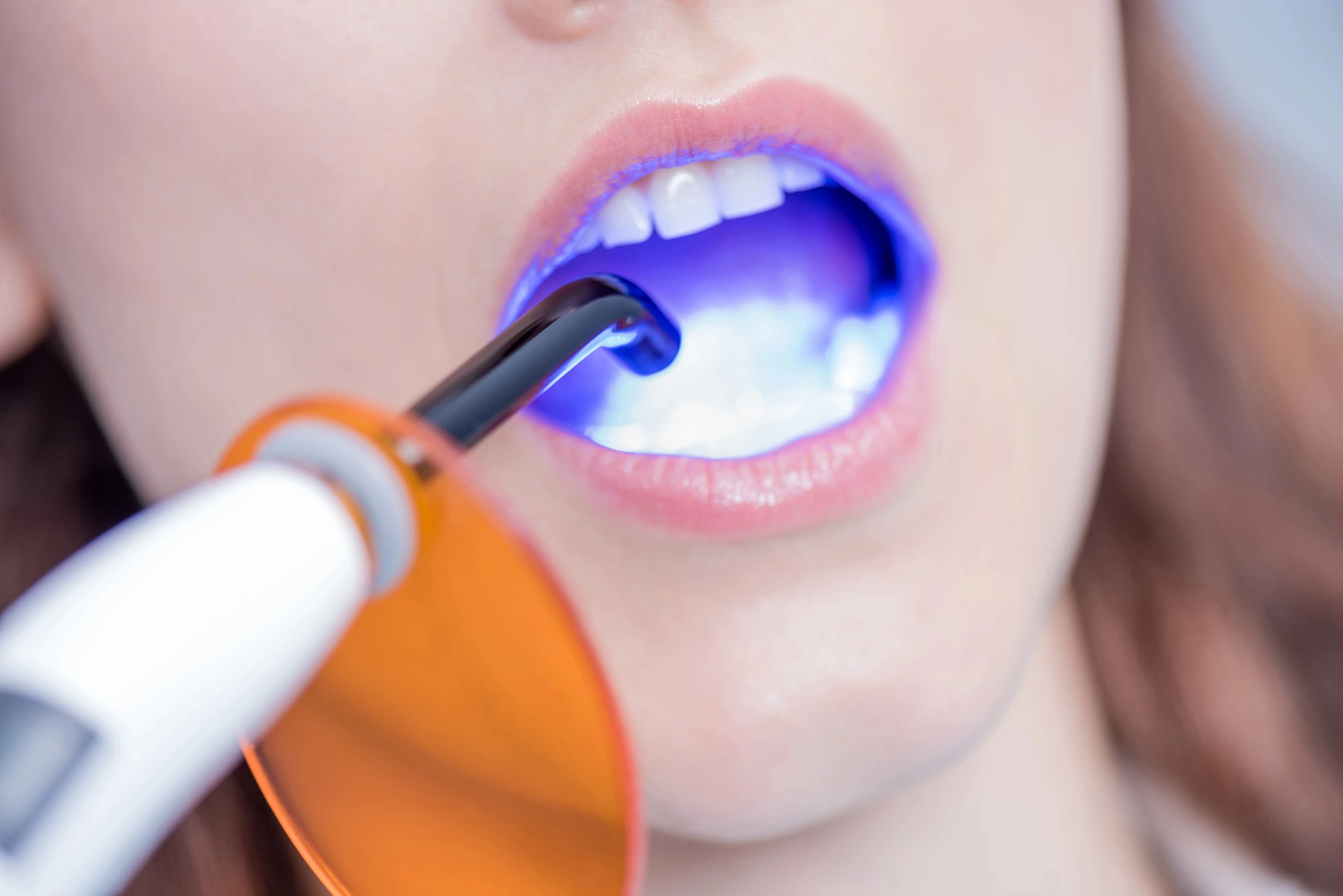 close up of mouth getting teeth whitening in Leesburg, VA