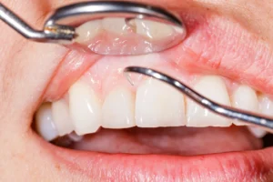 gums at Loudoun County dentist